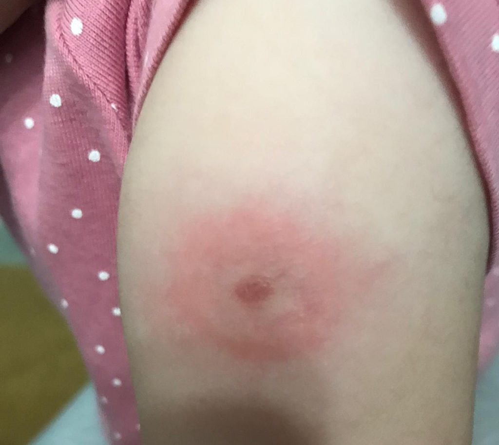 Termoli, bambini nel parco punti dalle zecche: furibondi i genitori