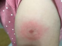 Termoli, bambini nel parco punti dalle zecche: furibondi i genitori