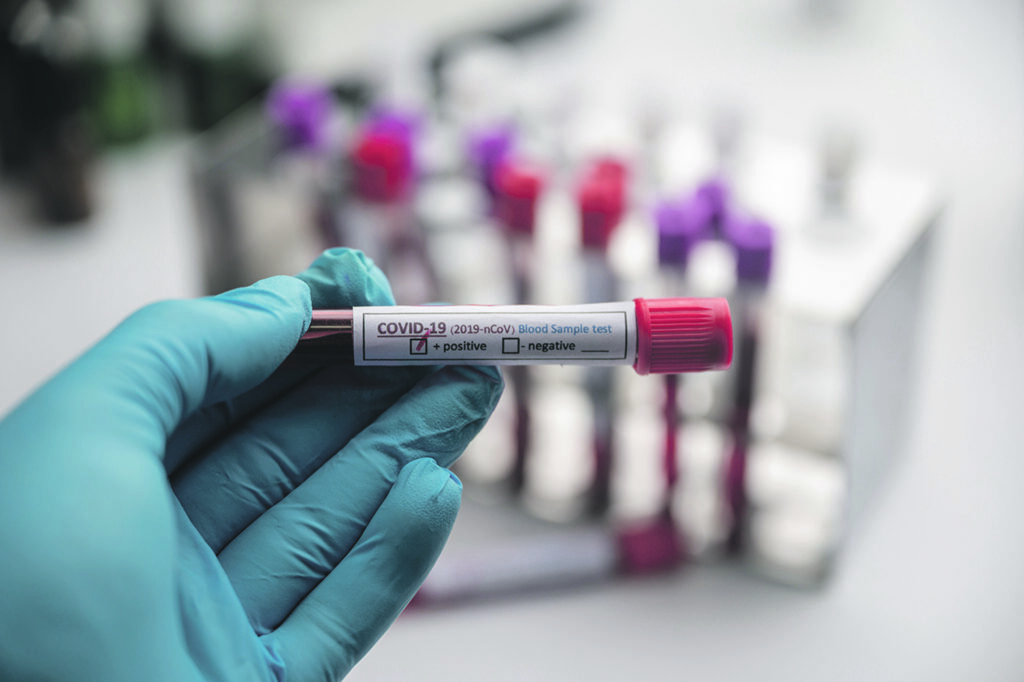 Blood test samples for presence of coronavirus (COVID-19) tube containing a blood sample that has tested positive for coronavirus.
