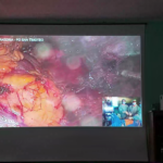 Al San Timoteo due interventi mini invasivi e innovativi 3D