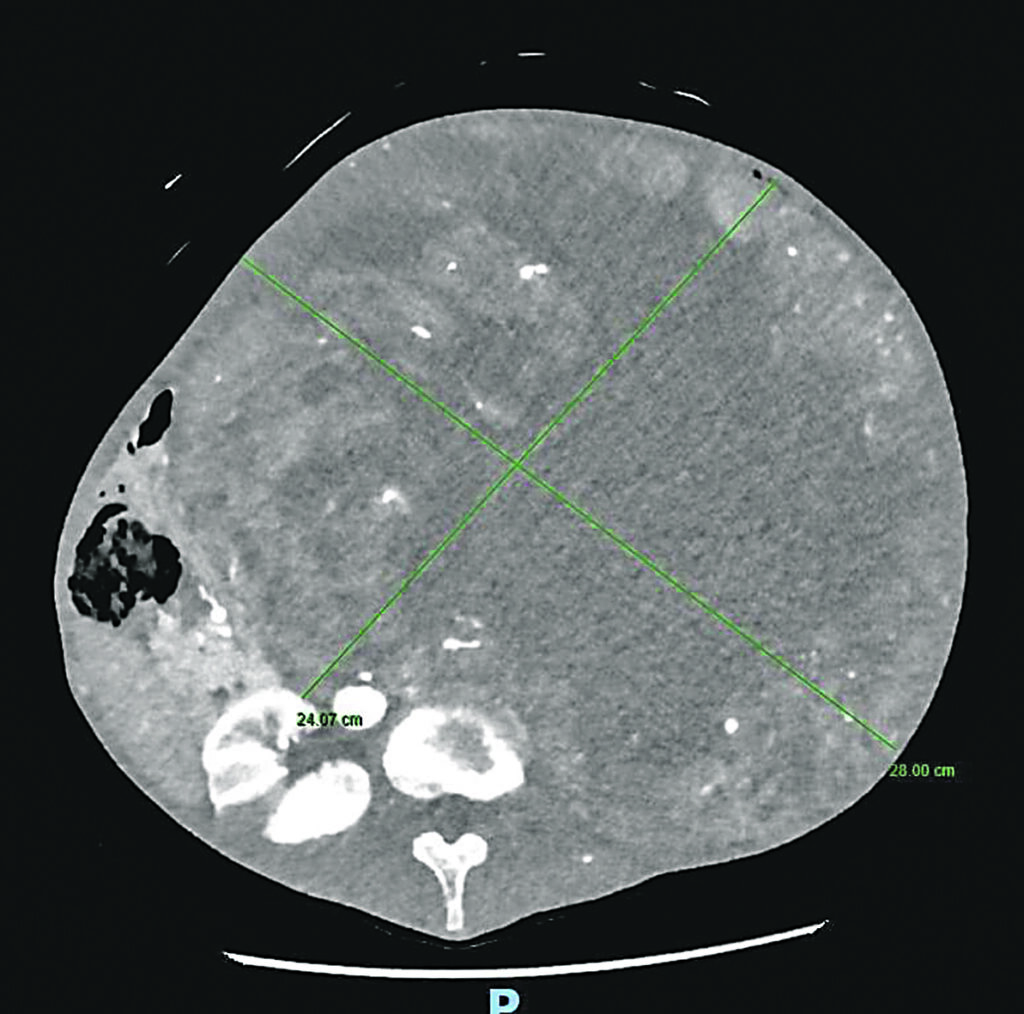 Intervento eccezionale al Cardarelli, rimosso un tumore di oltre 15 chili