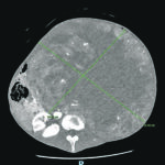 Intervento eccezionale al Cardarelli, rimosso un tumore di oltre 15 chili