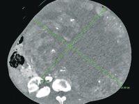 Intervento eccezionale al Cardarelli, rimosso un tumore di oltre 15 chili