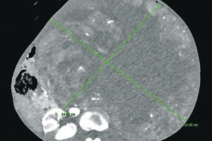 Intervento eccezionale al Cardarelli, rimosso un tumore di oltre 15 chili