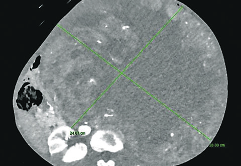 Intervento eccezionale al Cardarelli, rimosso un tumore di oltre 15 chili